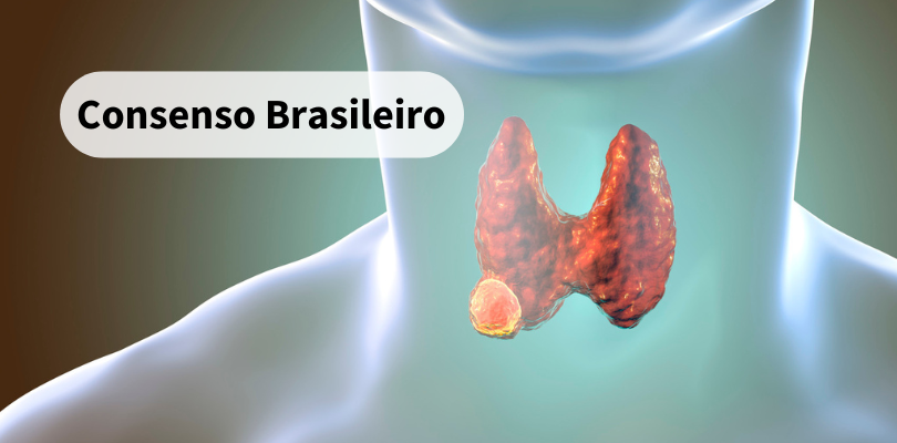 Consenso Brasileiro sobre Aplicação de Ablação Térmica  para Tratamento de Nódulos da Tireoide: uma declaração da força-tarefa da SOBRICE, SBCCP e SBEM